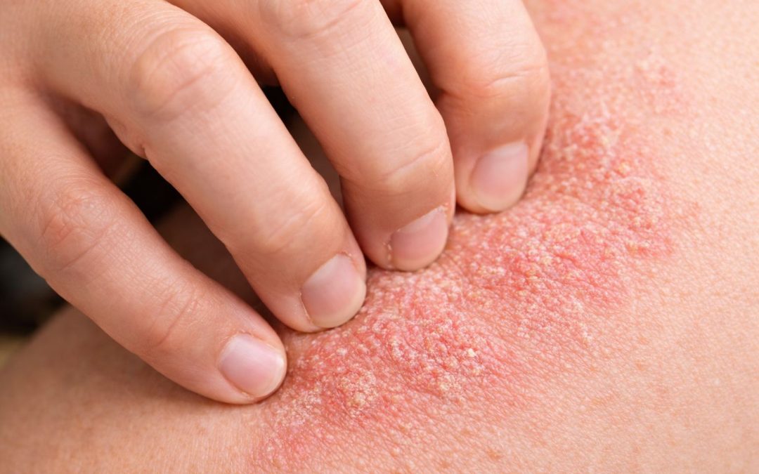 Enzima Dalam Karpet: Punca Gatal dan Alahan Yang Ramai Tak Sedar